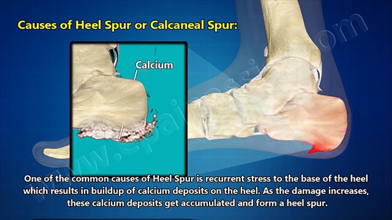 Heel Spur Or Calcaneal Spur Treatment Causes Symptoms Prevention