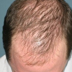 Na wypadanie włosów