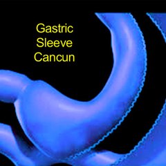 Gastric Sleeve Cancun