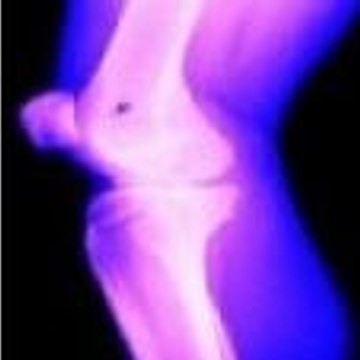 Knee Resurfacing