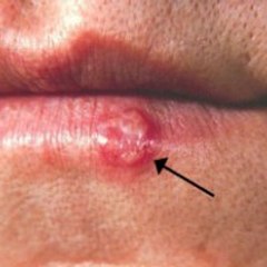 How To Get Rid Of Canker Sores