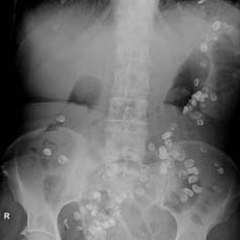 What Side is Your Appendix on