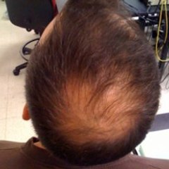 Receding Hairline Treatment
