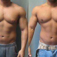 Gynecomastia