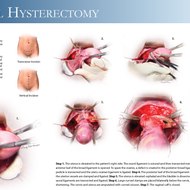 Abdominal Hysterectomy