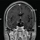 Pachymeningitis