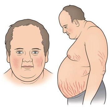 Cushing's Syndrome