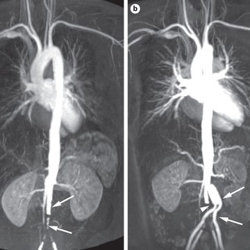 Takayasu Arteritis