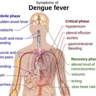 Dengue Fever