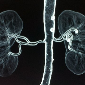 Renal Artery Stenosis