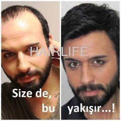Hairlife Saçlandırma