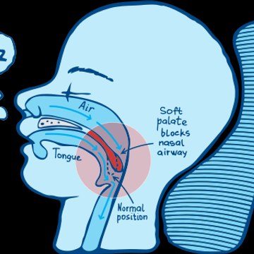 Antisnoringdevices