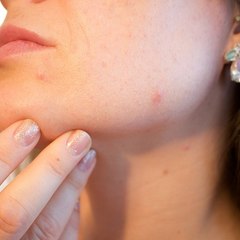 Acne Tablets UK