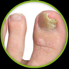 Cure Toenail Fungus