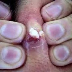 Pimple Popper Addict