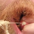 pimples