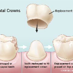 Dental-crowns739