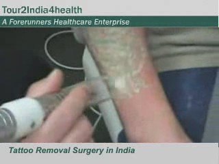 Tattoo removal cosmetic surgery in India with sizzling holid