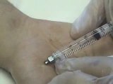 Botox Procedure for Palmar Hyperhidrosis