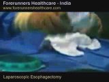 Esophagectomy in India: Medical recovery at low cost