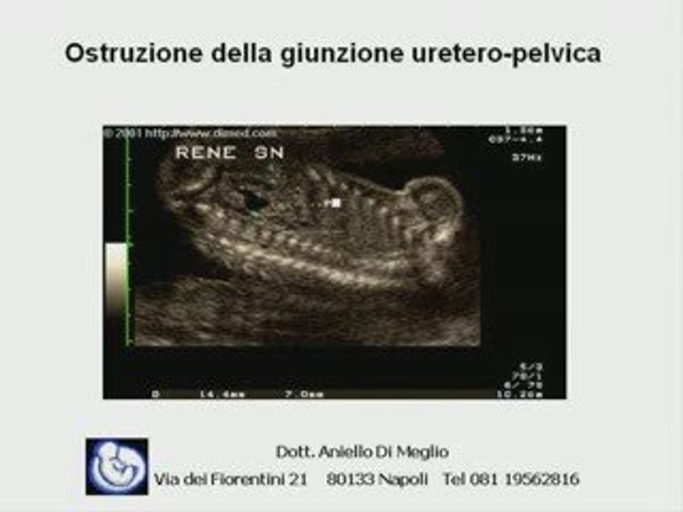 Pelvi renale