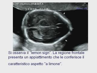 spina bifida aperta