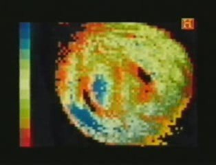 HISTORIA DE LA RESONANCIA MAGNETICA