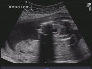 Arnold chiari tipo 2