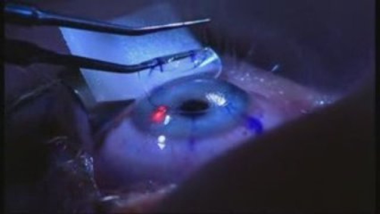 Alex Cookson's Eye Surgery Experience