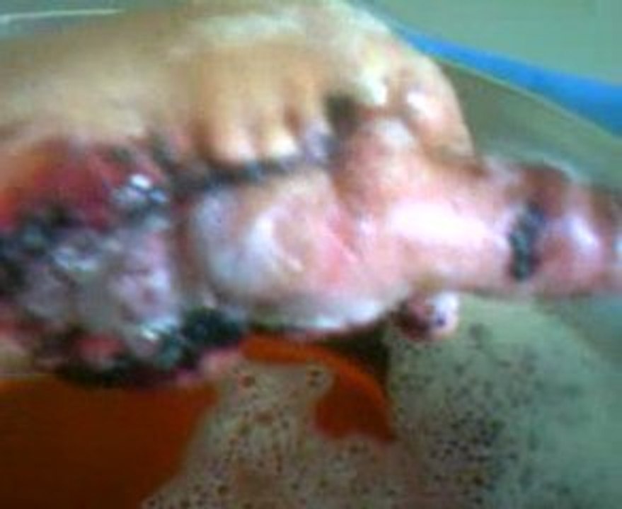 blessure kalach2