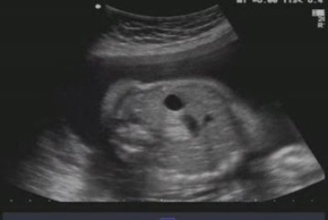 atresia duodenale