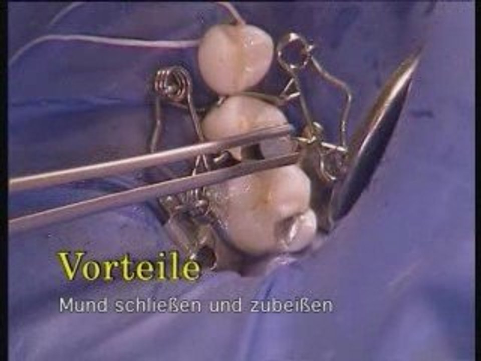 Walser® Teilmatrizen: Anwenderfilm in Zahnarztpraxis