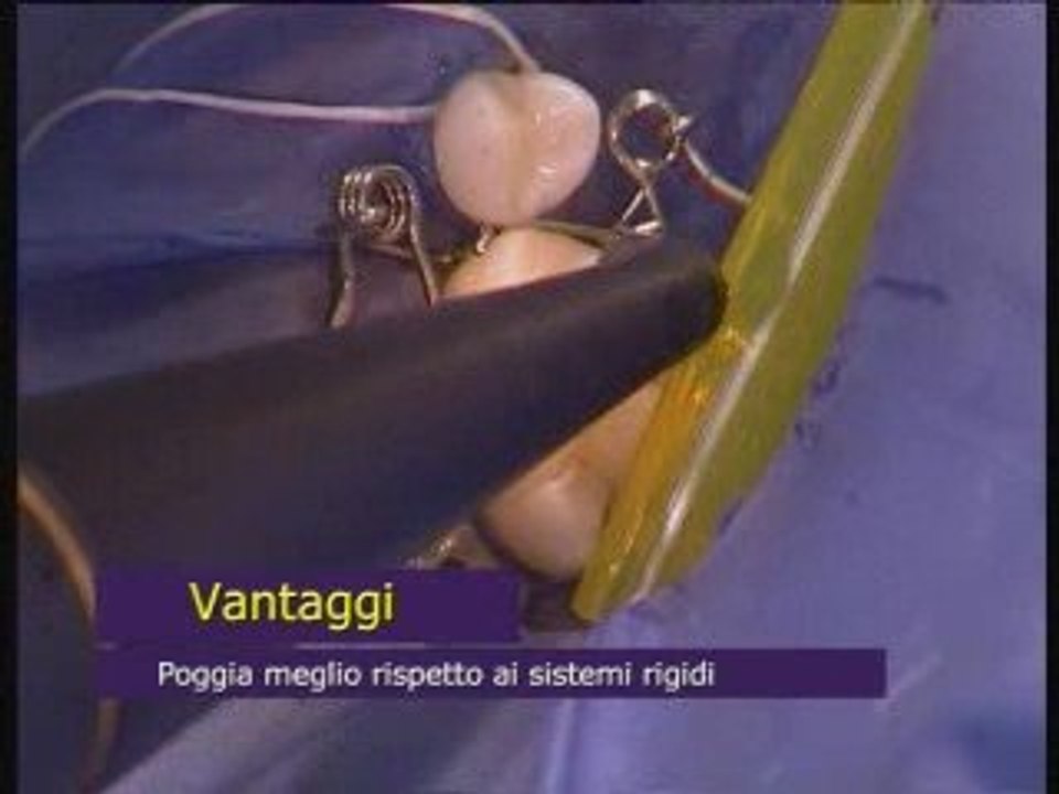 Walser® Matrici Sezionali: Film di utente nella pratica di medico di dente