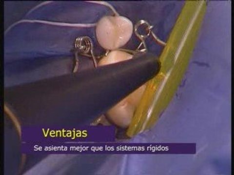 Walser® Matrices Seccionales: Película de usuario en la práctica de médico de diente