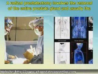 Prostate Cancer Treatment Options