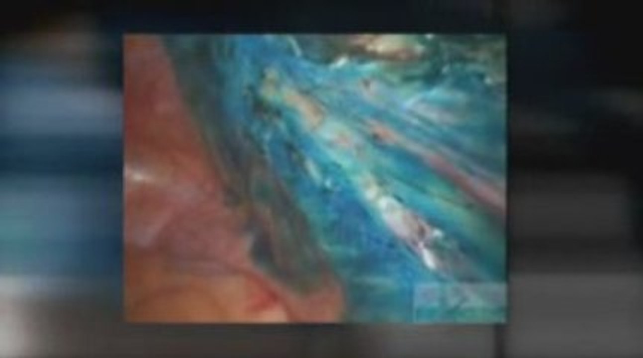 Video über verwachsungen