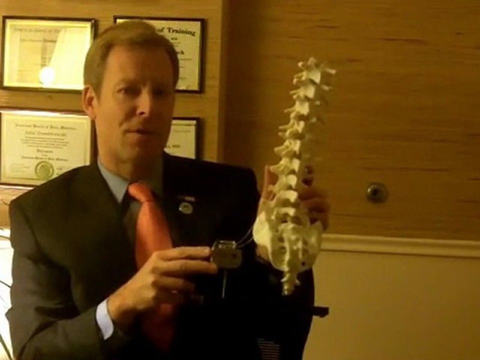 Spinal Cord Stimulation Implantation For Back Pain