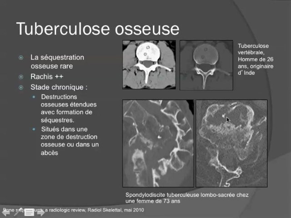 Les sequestres osseux : quelles étiologies? - Vidéo Dailymotion