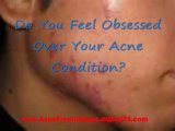 Ways to Eliminate Acne - How to Get Rid Acne Scars Naturally