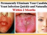 natural remedies for yeast infections - yeast infection natural treatment - yeast infection in women