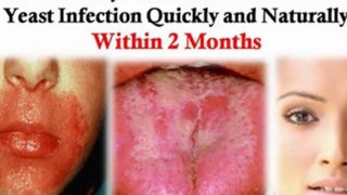 natural remedies for yeast infections - yeast infection natural treatment - yeast infection in women