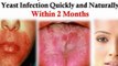natural remedies for yeast infections - yeast infection natural treatment - yeast infection in women