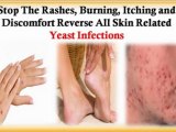 home remedy for yeast infection - how to prevent yeast infections - yeast infections in women