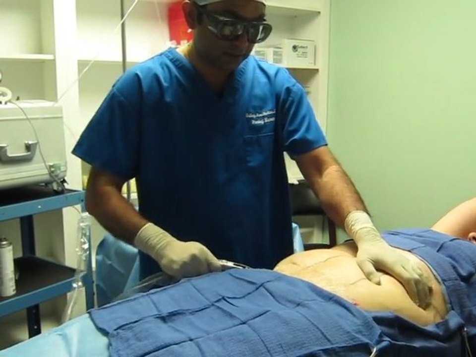 SmartLipo Laser Liposuction- Los Angeles County-Orange County-Riverside County-San Bernardino County-Inland Empire-Anaheim-Fullerton-Beverly Hills-Pasadena-Burbank-Hollywood-Cerritos-Long Beach-Irvine-Costa Mesa-Orange-Brea-Whittier-Pomona-Chino-Fontana