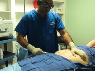 SmartLipo Laser Liposuction- Los Angeles County-Orange County-Riverside County-San Bernardino County-Inland Empire-Anaheim-Fullerton-Beverly Hills-Pasadena-Burbank-Hollywood-Cerritos-Long Beach-Irvine-Costa Mesa-Orange-Brea-Whittier-Pomona-Chino-Fontana