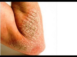 Napoli - Nuove cure per la psoriasi