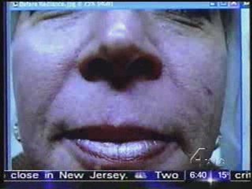 Botox, Restalyne, Chemical Peels, and Wrinkle Fillers beat b