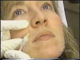 Restalyne Wrinkle filler