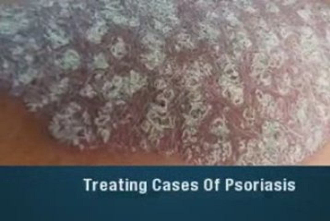 PSORIASIS CURE