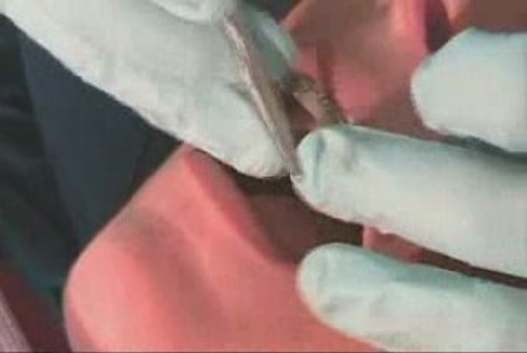 Dr. Guess puts in wire while patient is tied in? Into what?